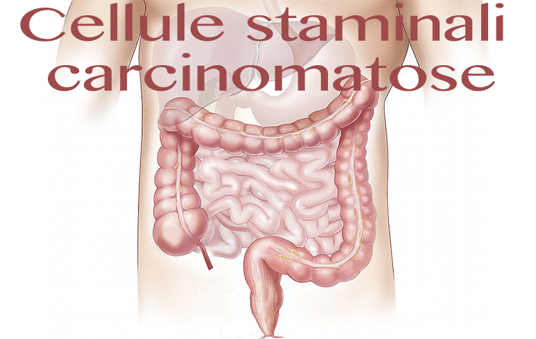 503_Cellule staminali carcinomatose